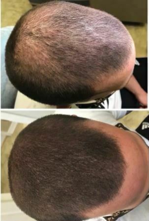 before and after scalp micropigmentation