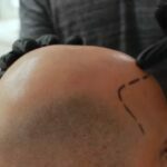 Before and after scalp micropigmentation
