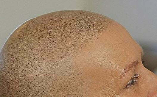 hairline correction: 3D Hair Effect