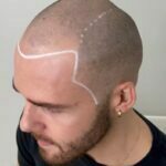 Hairline correction 1 - hairline correction 8 customized smp hairlines to choose from