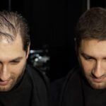 Hair density