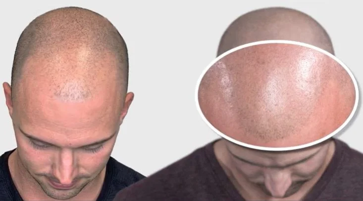 Micropigmentation