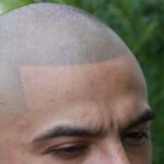Scalp micropigmentation cost