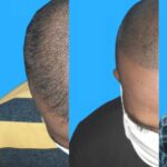 Scalp pigmentation