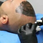 Tricopigmentation 1 - tricopigmentation benefits