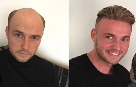 Replacement hair systems