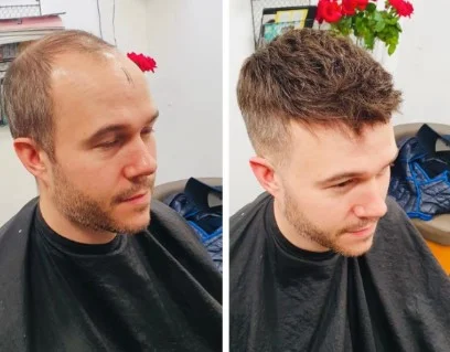 Replacement hair systems