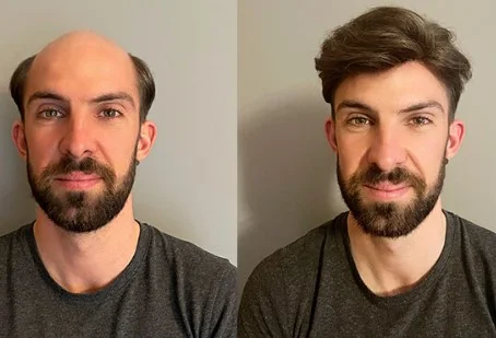 Replacement hair systems